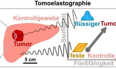 Tumor-assoziiert mikroskopische Effekte wie die Verflüssigung oder erhöhte Fließfähigkeit von Krebszellen haben Einfluss auf die makroskopischen mechanischen Eigenschaften des Tumors. Letztere lassen sich direkt im Körper mit Tomoelastographie messe Tumor-assoziiert mikroskopische Effekte wie die Verflüssigung oder erhöhte Fließfähigkeit von Krebszellen haben Einfluss auf die makroskopischen mechanischen Eigenschaften des Tumors. Letztere lassen sich direkt im Körper mit Tomoelastographie messen.