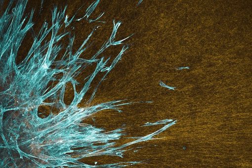 Auf dem Bild ist die Mikroskopieaufnahme von krebsassozierten Fibroblasten in cyanfraben zu sehen, die in ein rekonstituiertes Kollagengel als vereinfachtes Modell für Bindegewebe (gelb) einwandern.