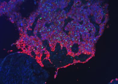 Fluoreszenzbild einer Tumorfront des Gebärmutterhals. Zellkerne wurden blau und sich teilende Zellen grün markiert. Tumorzellen, rot markiert, befallen und verdrängen gesundes Gewebe. Fluoreszenzbild einer Tumorfront des Gebärmutterhals. Zellkerne wurden blau und sich teilende Zellen grün markiert. Tumorzellen, rot markiert, befallen und verdrängen gesundes Gewebe.