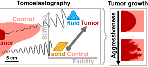 Tumour-associated microscopic effects such as the liquification or increased fluidity of cancer cells have an effect on the tumour’s macroscopic mechanical properties. These can then be measured directly in a patient’s body using tomoelastography.